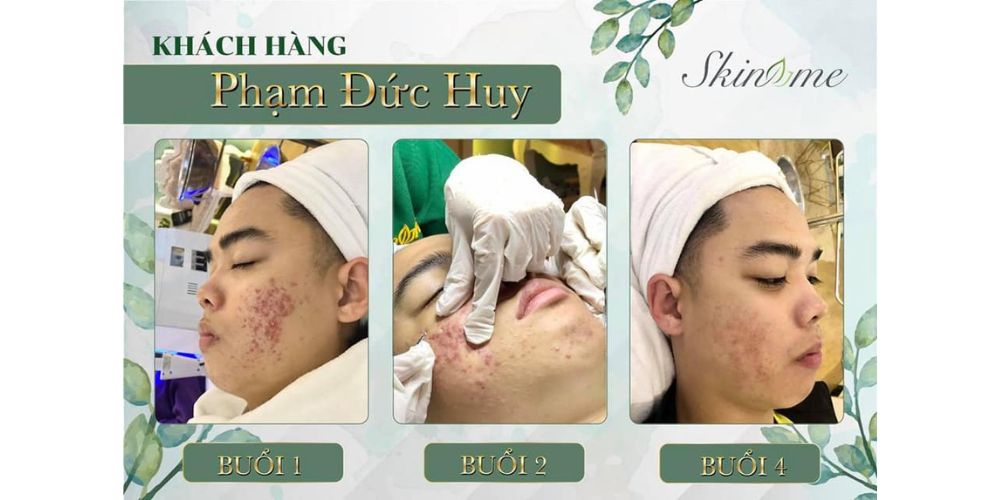 Trị Mụn Căng Bóng Da Công Nghệ Mỹ