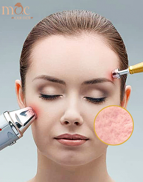 Điều Trị Sẹo Rỗ