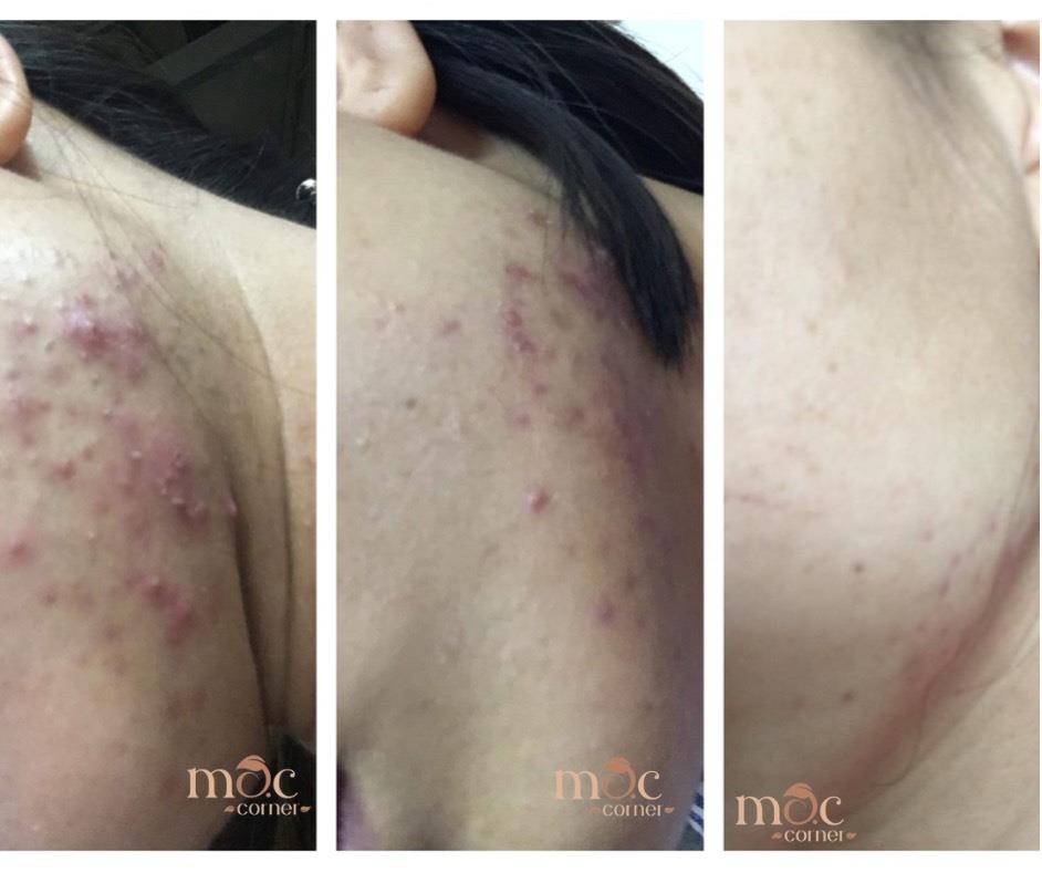 ĐIỀU TRỊ MỤN DIAMOND SIÊU CĂNG BÓNG 