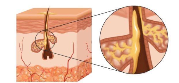 TẤT TẦN TẬT VỀ DA DẦU - CHĂM SÓC DA DẦU ĐÚNG CÁCH - PHẦN 2 